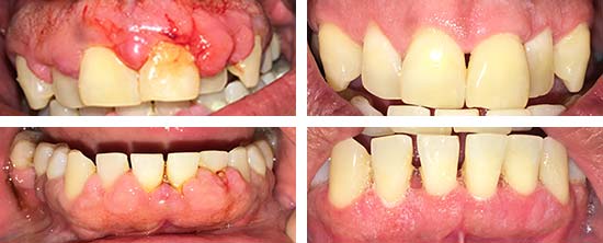 Osseous Surgery Before and After Results