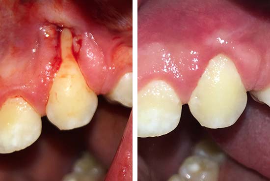 Gum Graft Before and After Results