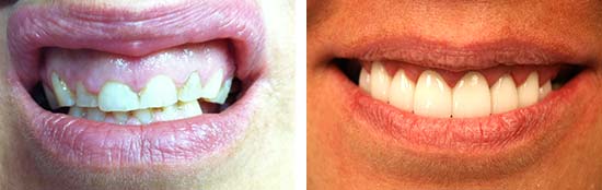 Esthetic Crown Lengthening Before and After Results