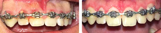 Esthetic Crown Lengthening Before and After Results